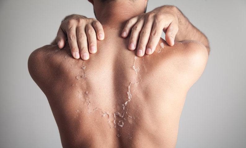 曬傷第幾天脫皮?皮膚醫學專家教你高效預防與舒緩曬傷